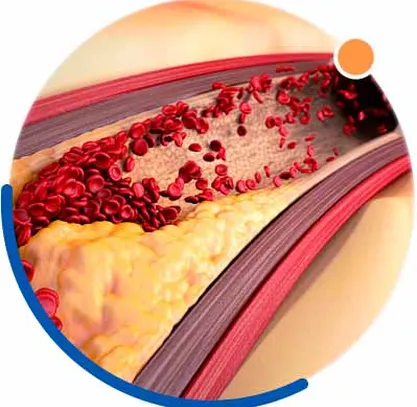 Полезная информация про атеросклероз