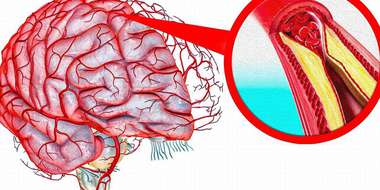 Атеросклероз сосудов головного мозга: симптомы, диагностика, лечение