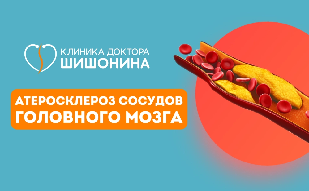 Атеросклероз сосудов головного мозга