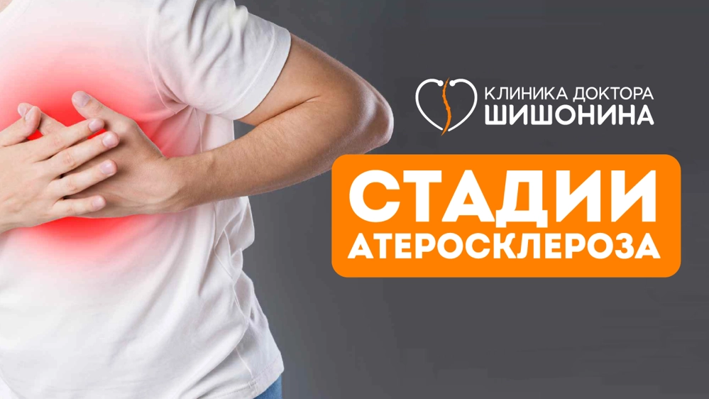 Стадии развития атеросклероза