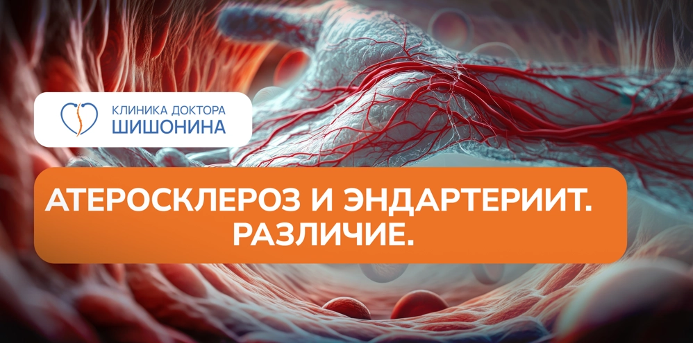 Различия между атеросклерозом и эндартериитом