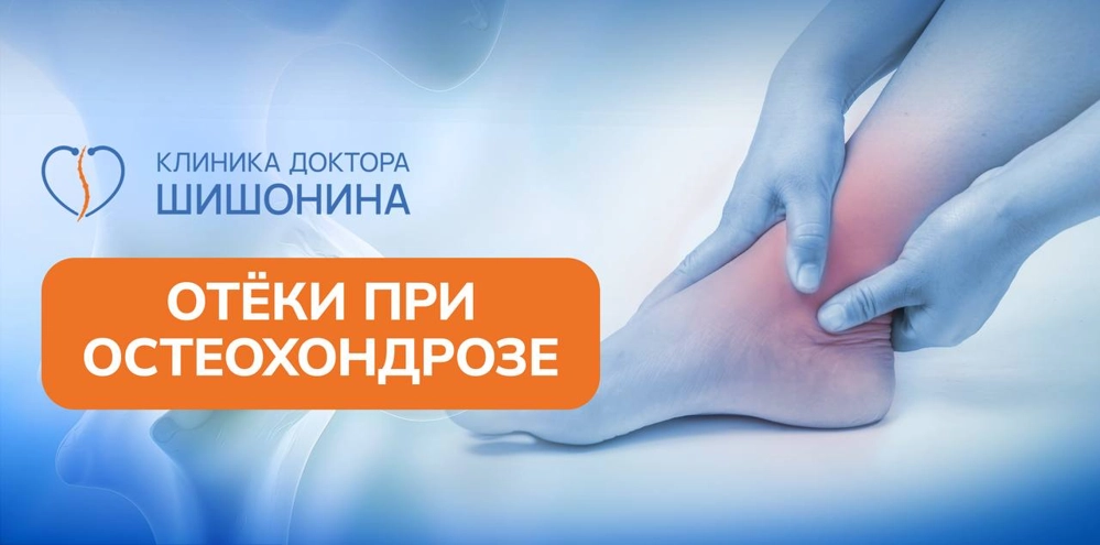 Отеки горла при шейном остеохондрозе