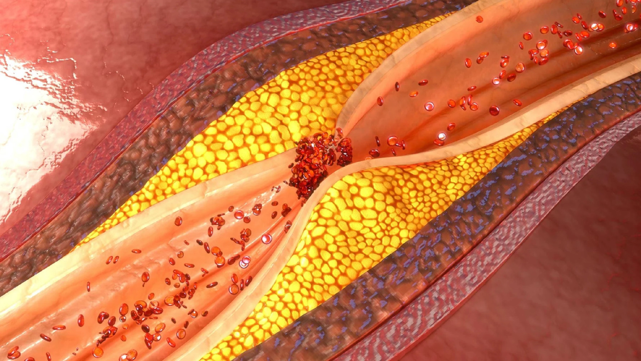 Атеросклеротическая бляшка