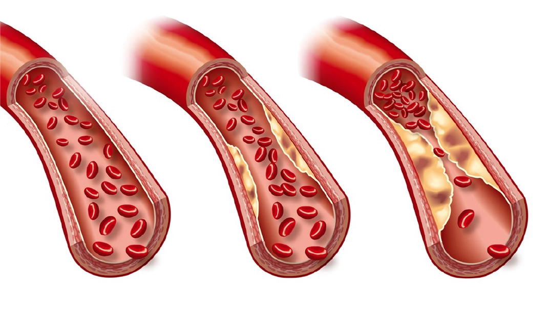 Вид атеросклеротической бляшки