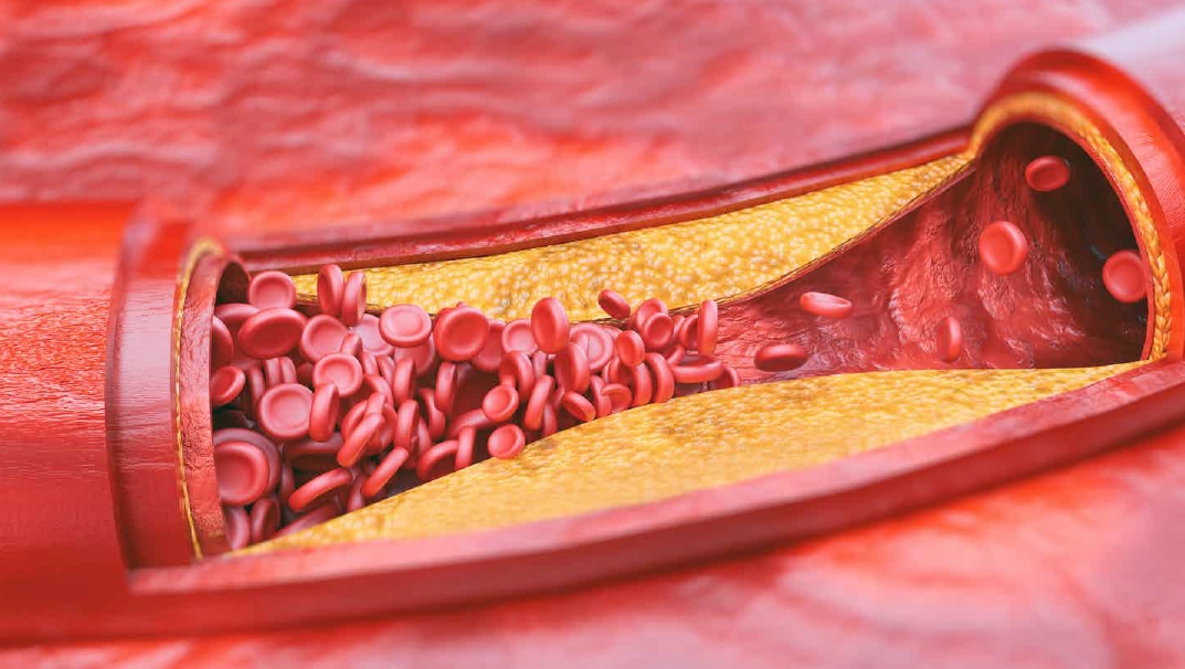 Атеросклероз сосудов