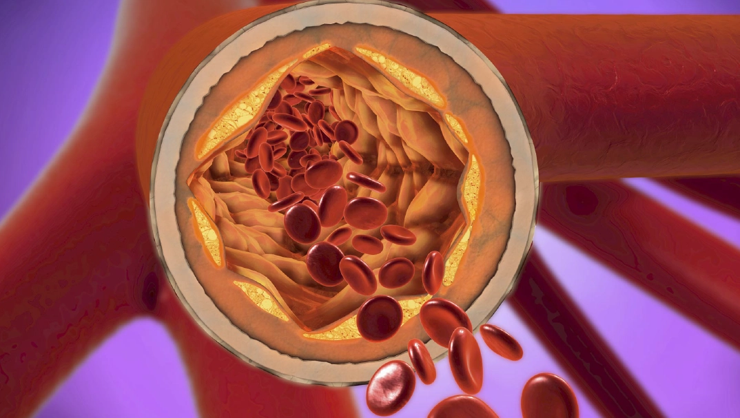 Атеросклероз нижних конечностей