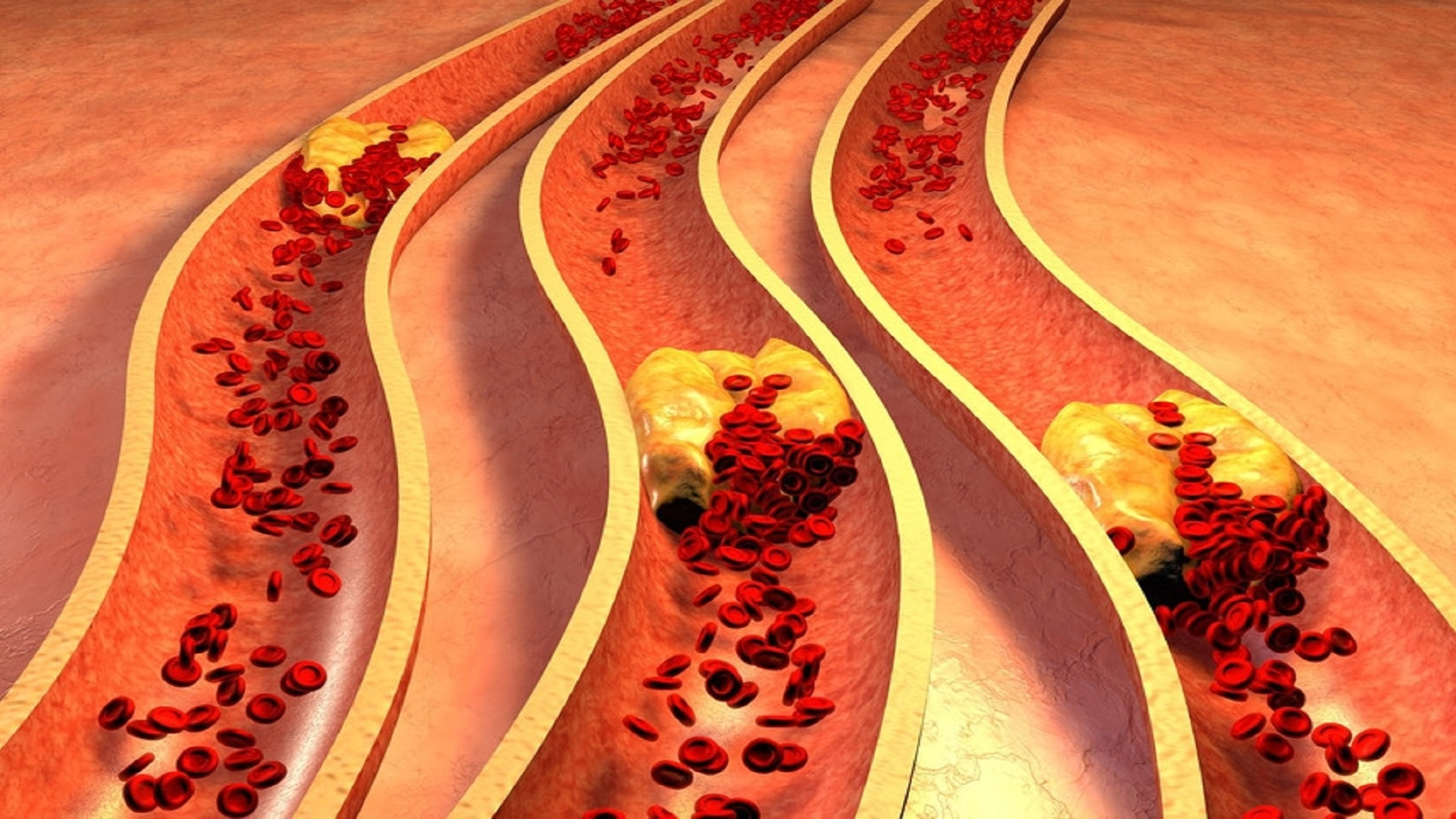 Образование атеросклеротической бляшки