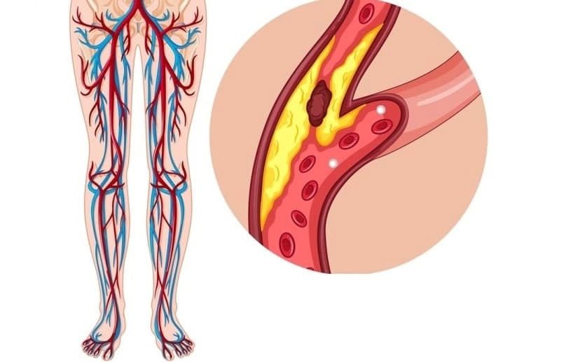 Забитые сосуды