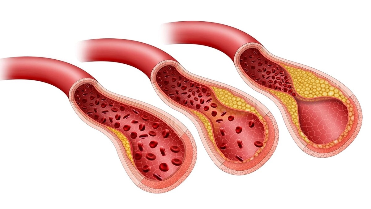 Бляшки в сосудах