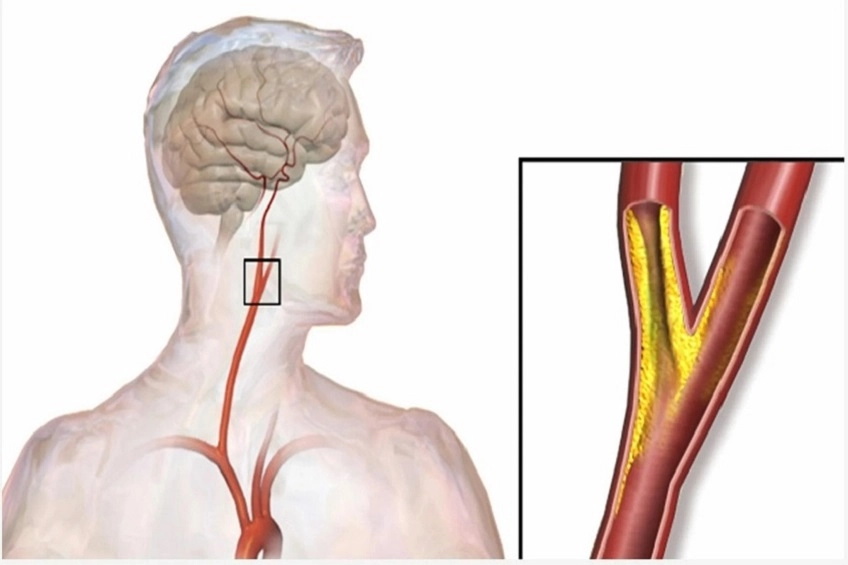 Сонные артерии человека