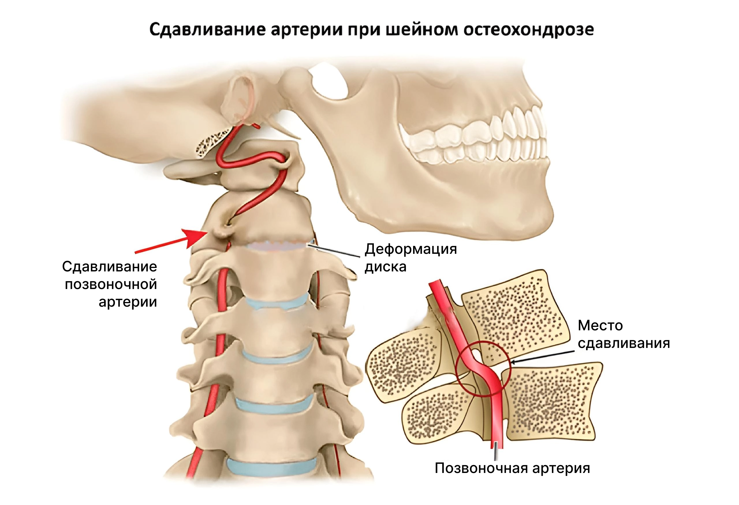 Изображение сдавленных позвоночных артерий