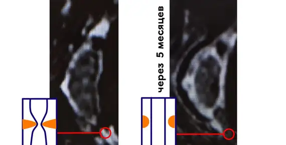 Восстановление артериального кровотока