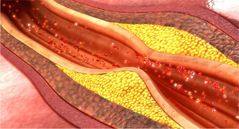 Лечение атеросклероза без лекарств и операций