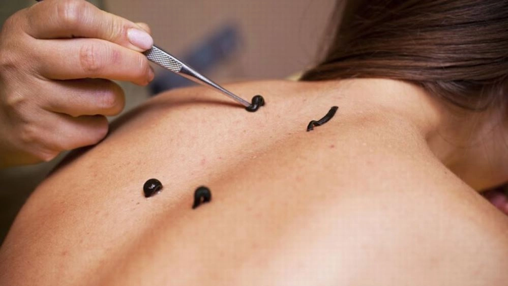 Лечение остеохондроза гирудотерапией