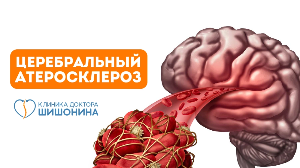 Развитие церебрального атеросклероза