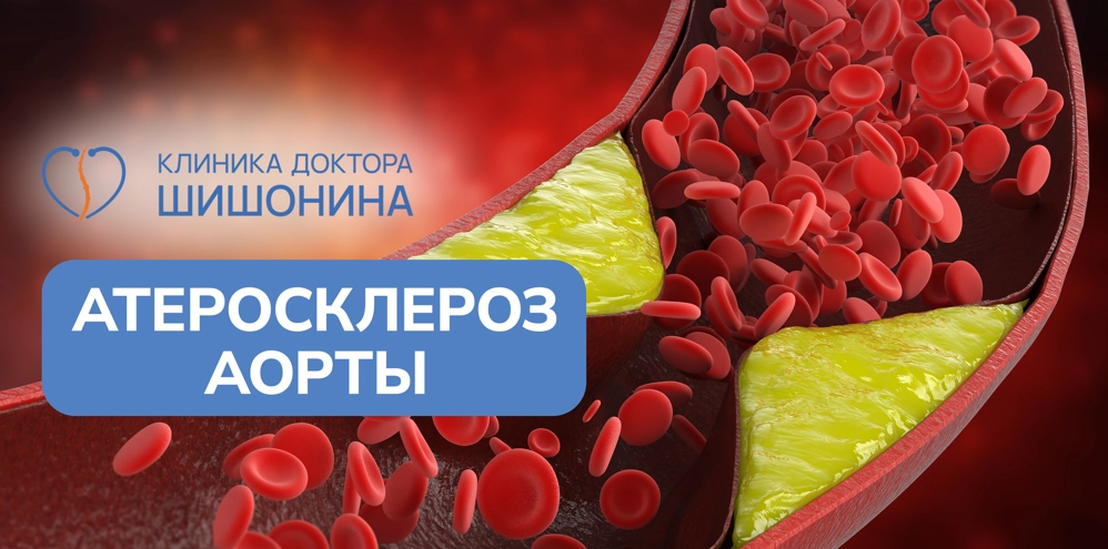 Лечение атеросклероза аорты