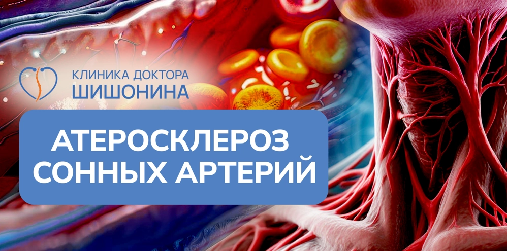 Атеросклероз сонных артерий