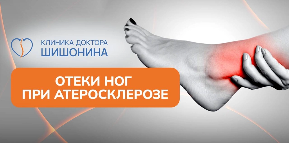 Отеки ног и атеросклероз
