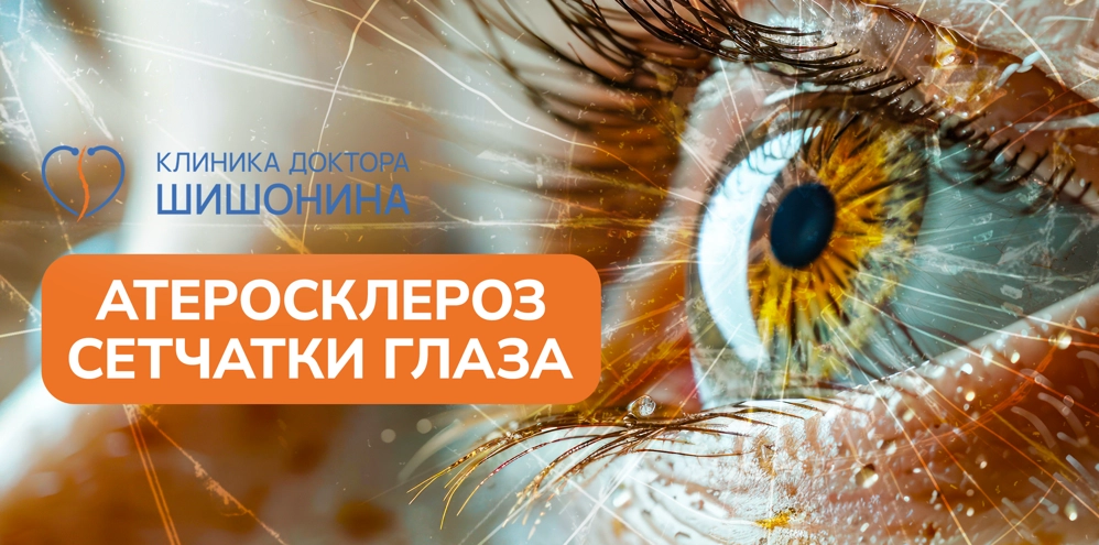 Лечение атеросклероза сетчатки глаза