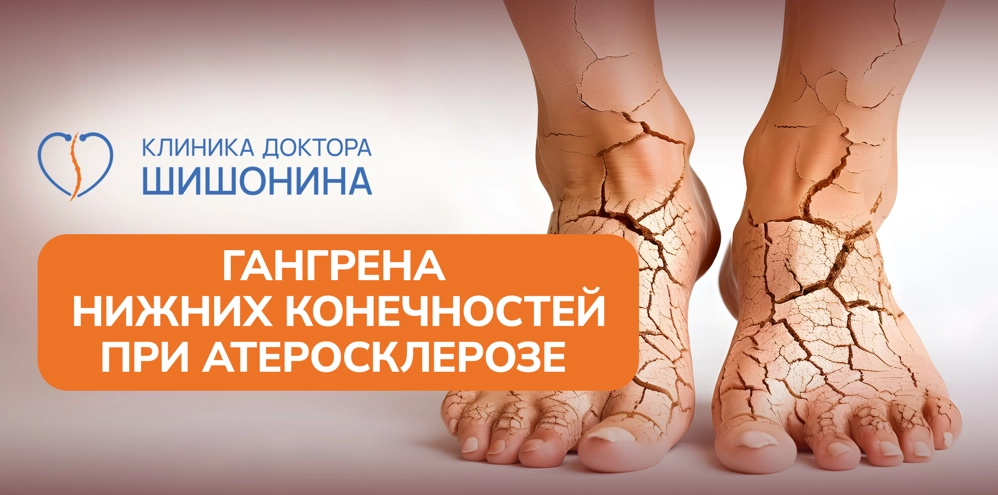 Гангрена нижних конечностей при атеросклерозе