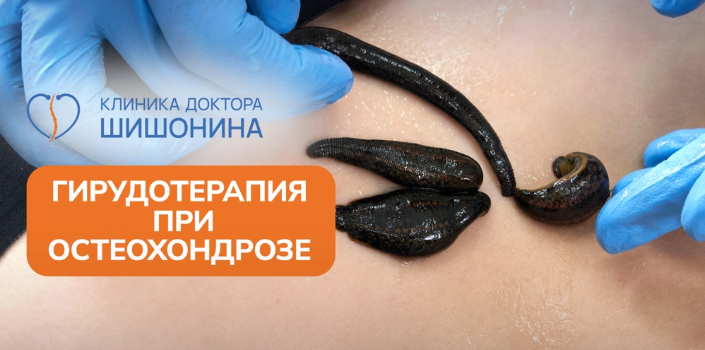 Лечение остеохондроза гирудотерапией