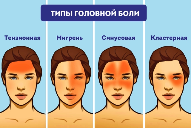 Изображение локализации головных болей