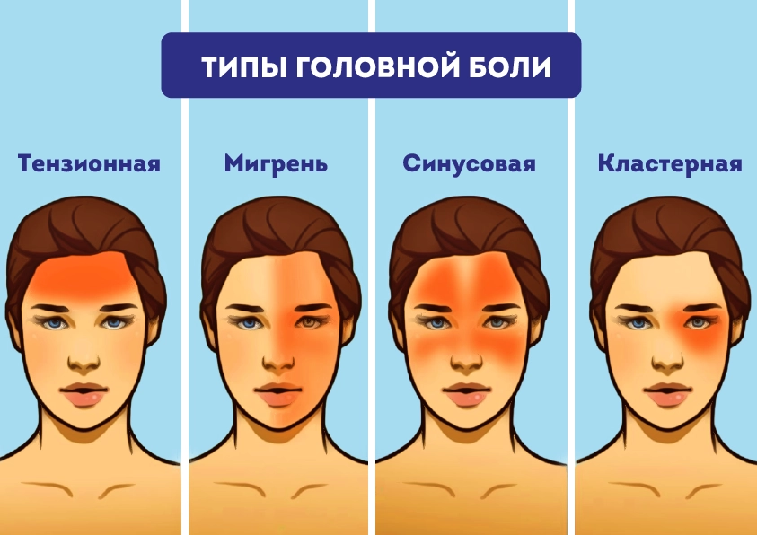 Изображение локализации головных болей