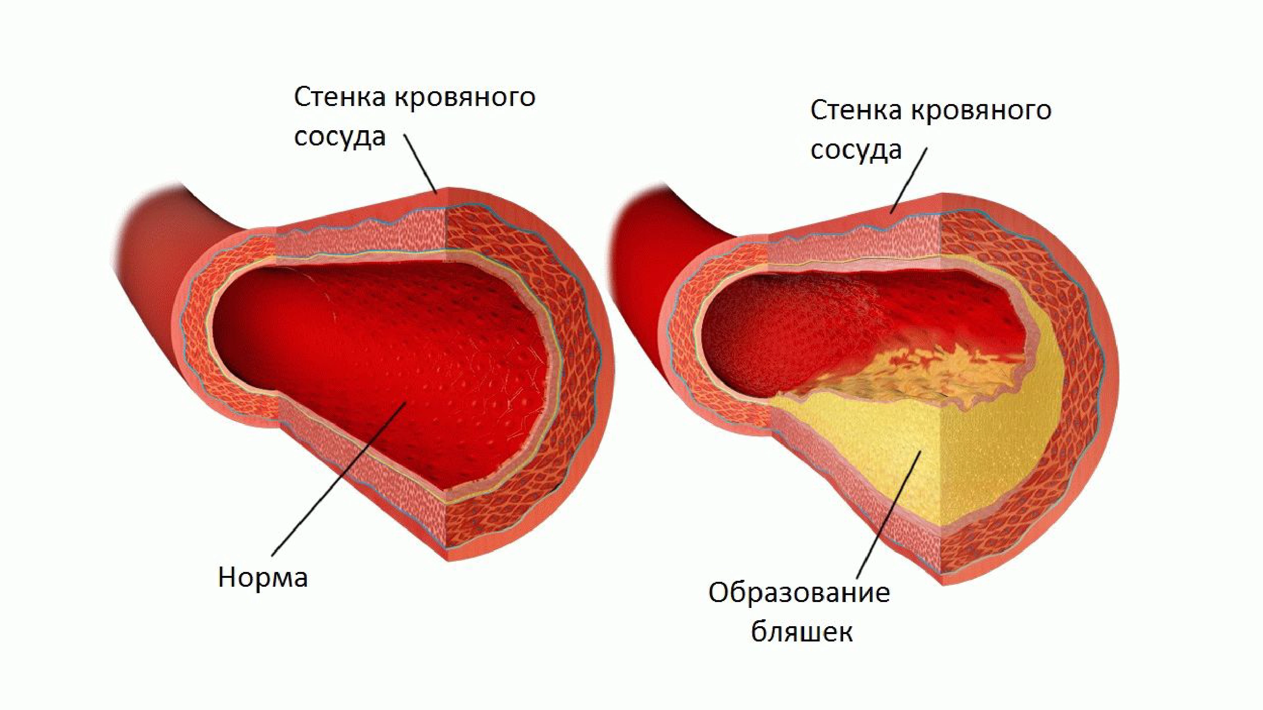 Внешний вид атеросклеротической бляшки