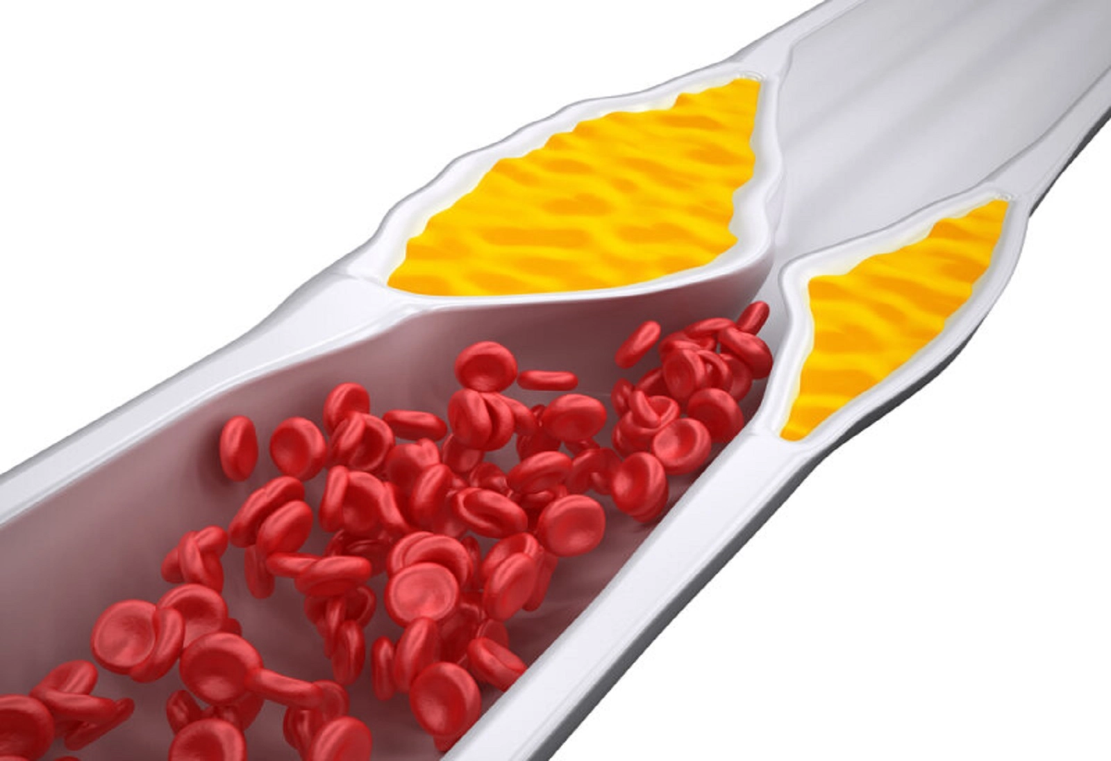 Атеросклеротическая бляшка в сосуде