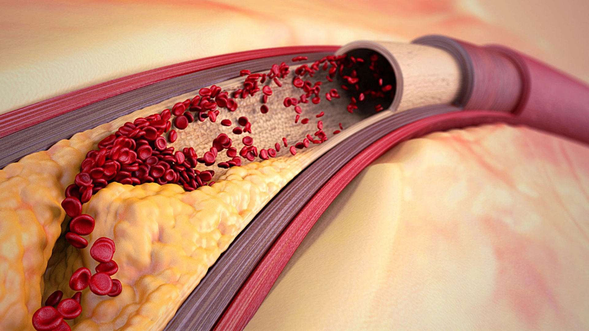 Образование бляшек в сосудах