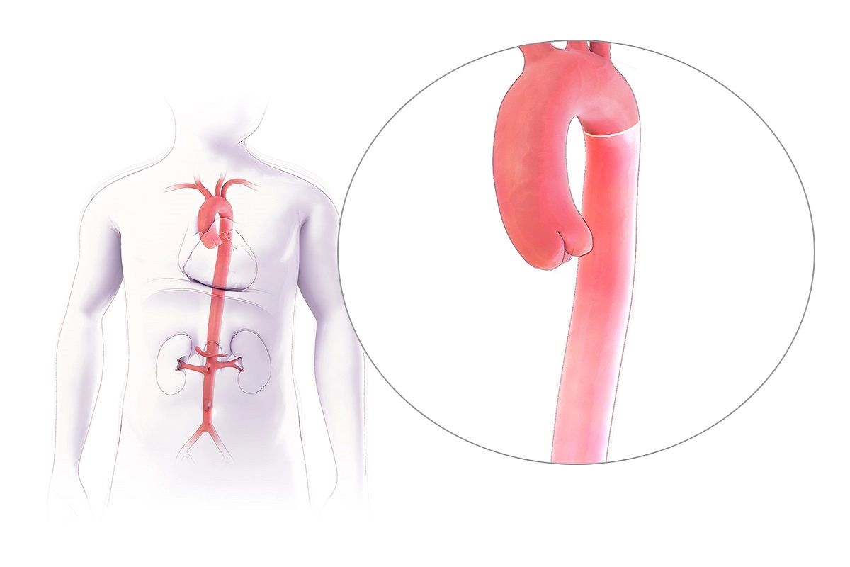Схематичное изображение аорты