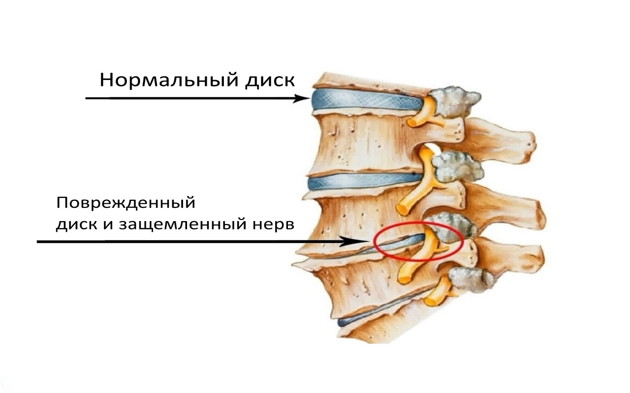 Поврежденный диск при остеохондрозе