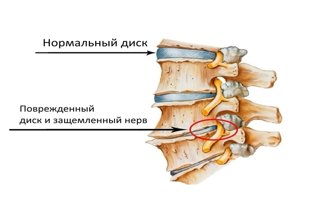 Поврежденный диск при остеохондрозе