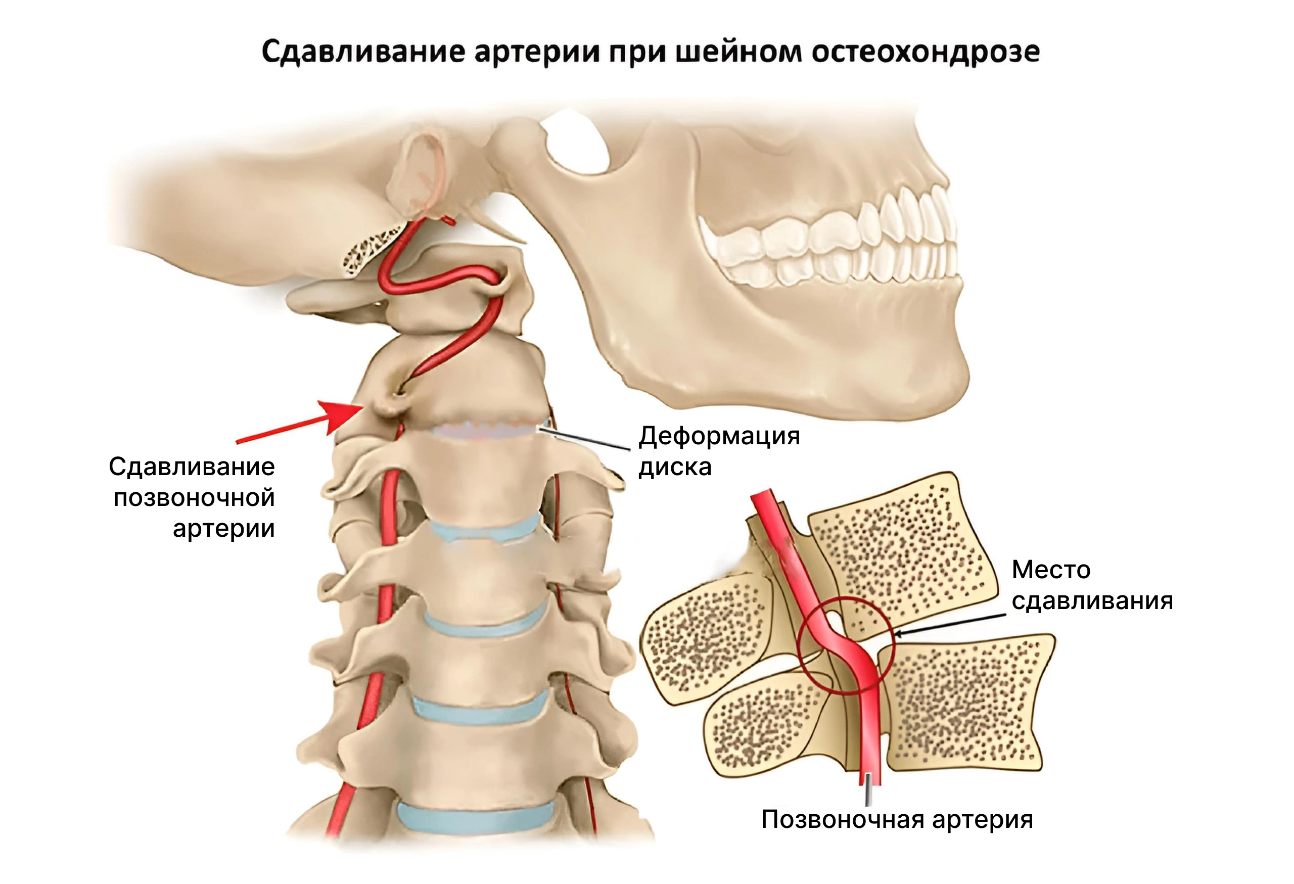 Изображение сдавленных позвоночных артерий