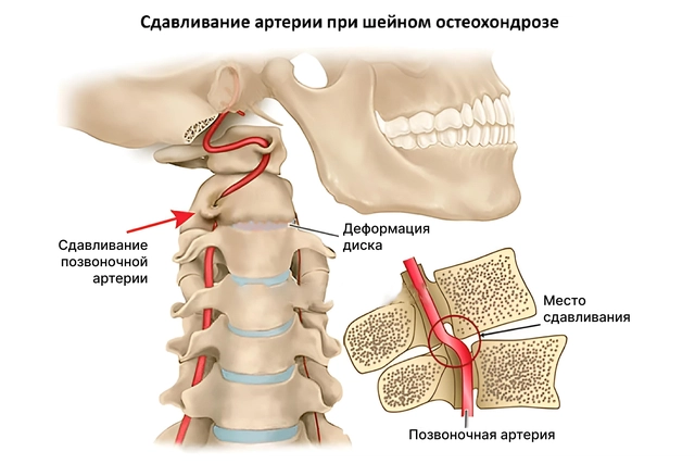 Изображение сдавленных позвоночных артерий