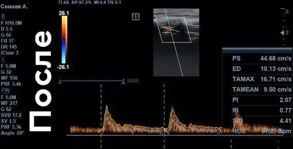 Скорость кровотока «ПОСЛЕ»