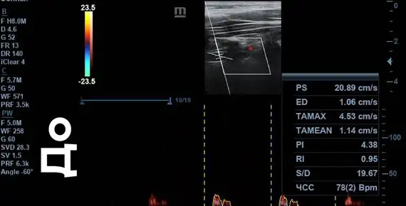 Скорость кровотока «ДО»