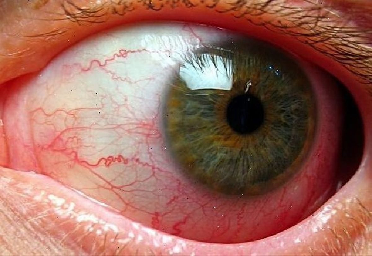 Атеросклероз сетчатки глаза