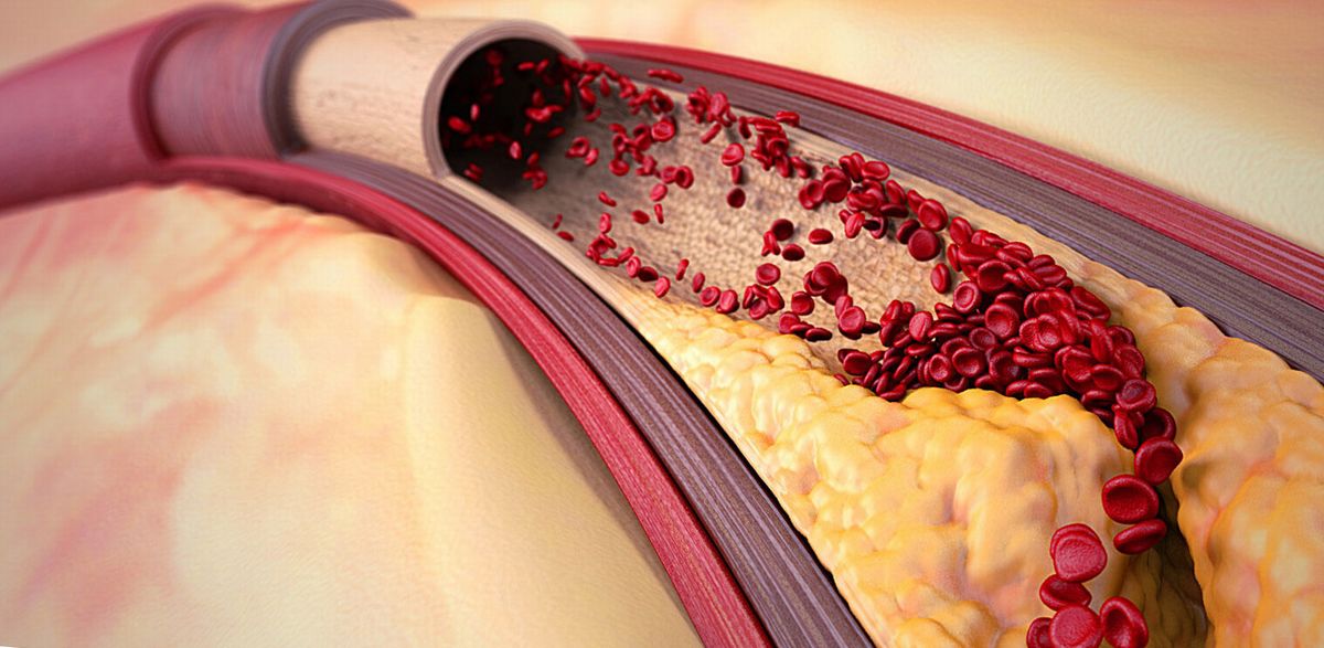 Атеросклероз коронарных артерий