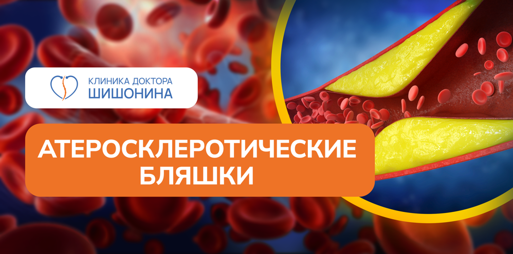 Атеросклеротические бляшки при атеросклерозе