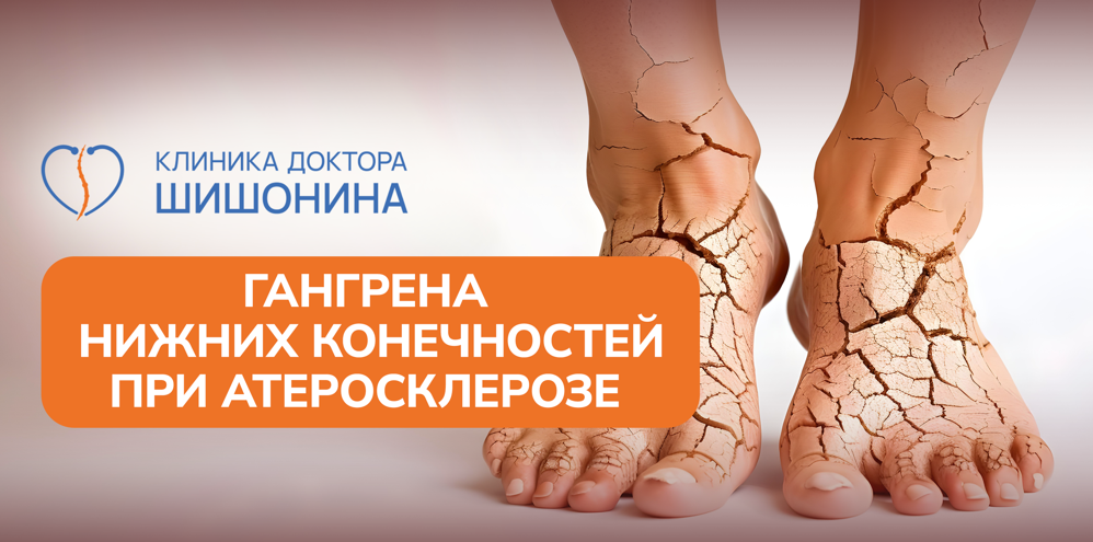 Гангрена нижних конечностей при атеросклерозе