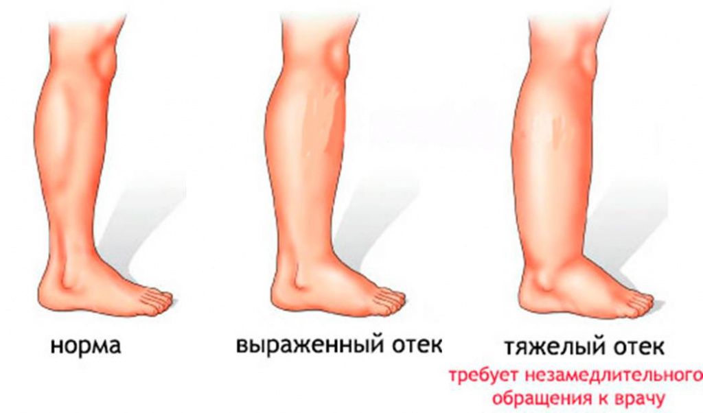 Причины отёков