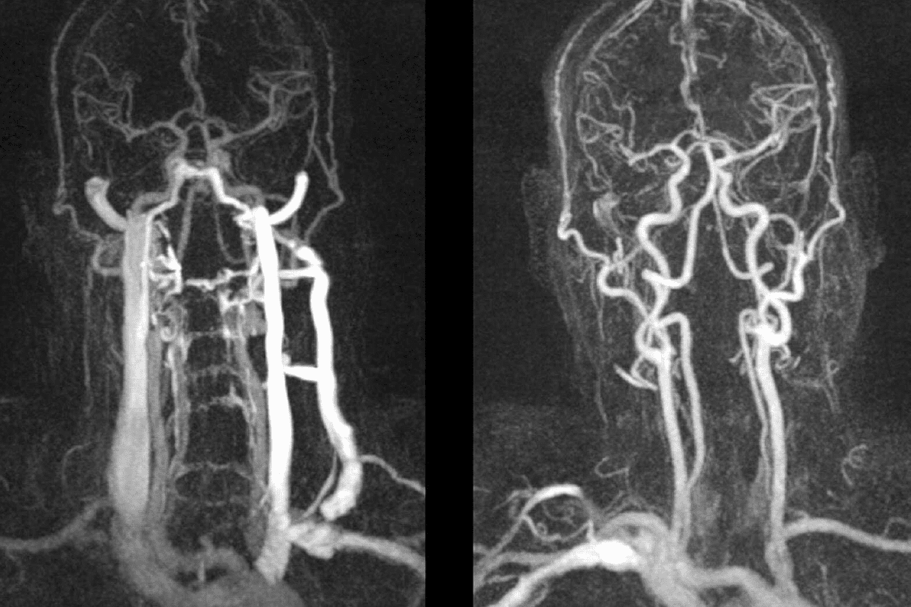 Изображение снимака МРТ позвоночных артерий: пример