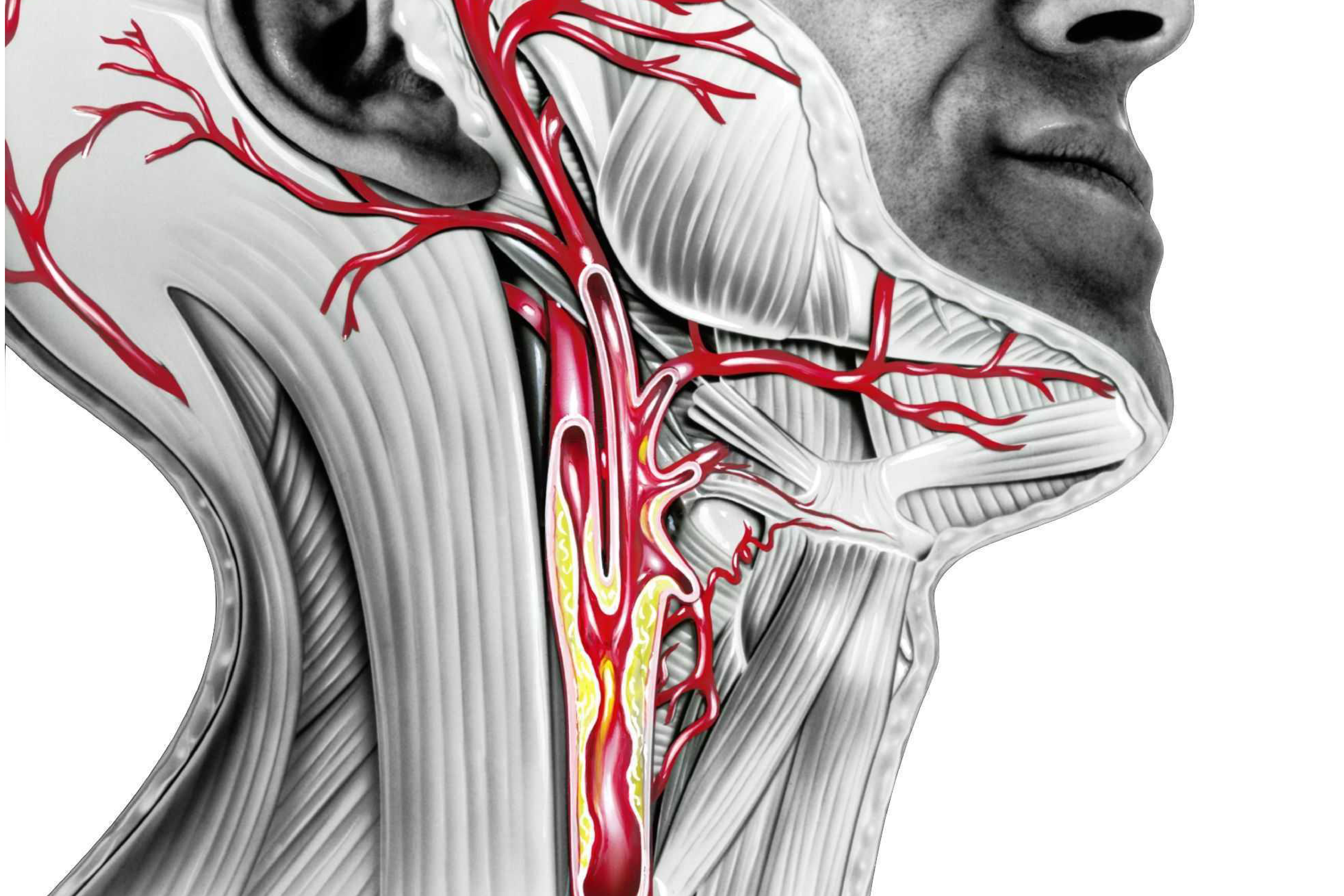 Атеросклероз сосудов шеи сонных артерий. Каротидный синус. Синдром каротидного синуса. Бляшки в каротидном синусе.